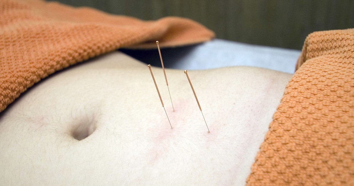 acupuncture développer son activité photo ventre aiguilles